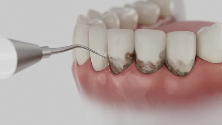 Trusted Wisdom Tooth Removal service in East Basin, UT - Dentist Open Now